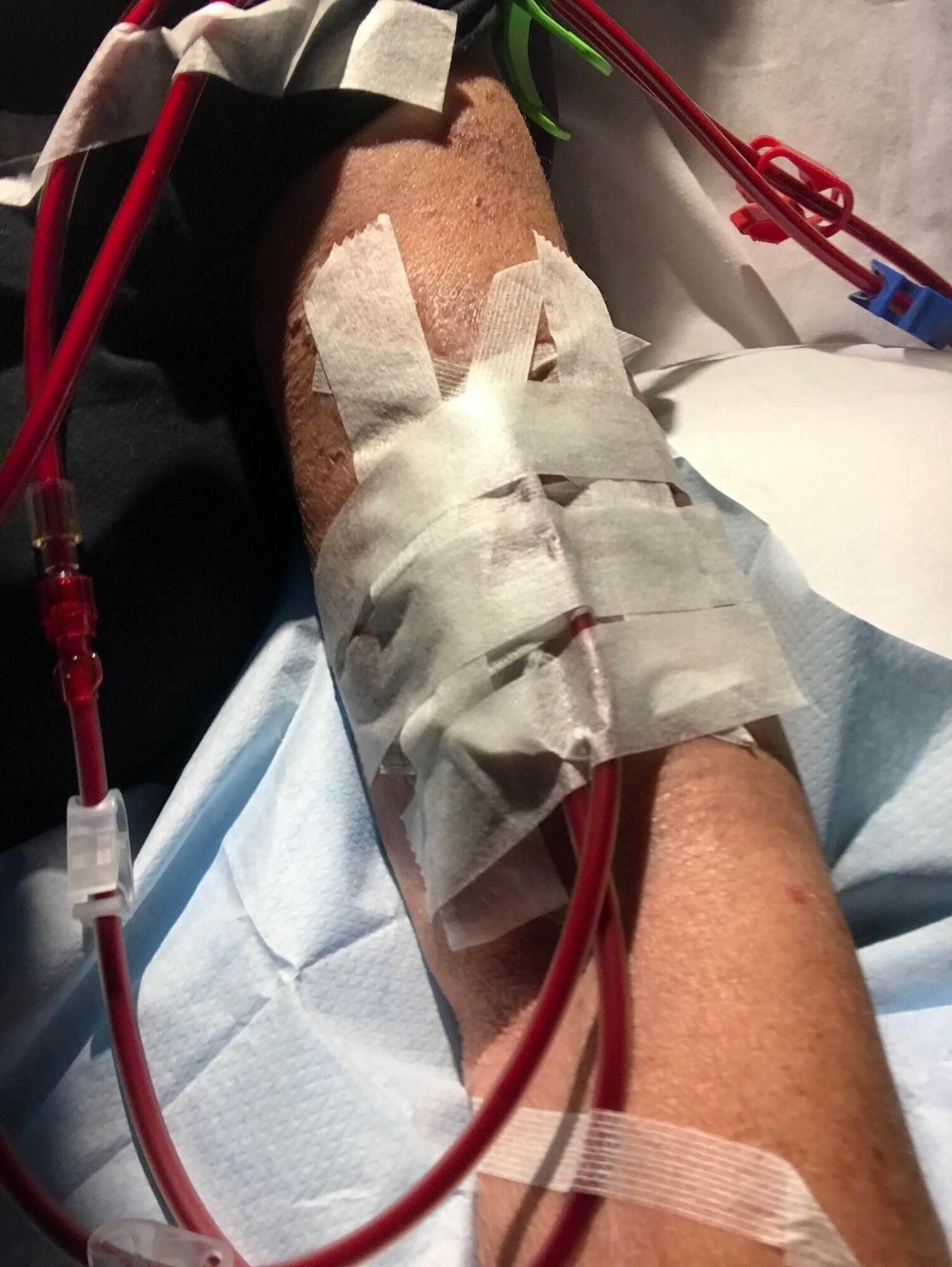 Torhild Jære har fått et nytt liv med hjemmedialyse.