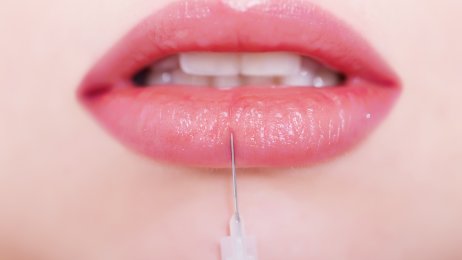 Bildet viser en sprøyte med botox som injiseres i kvinnelepper.