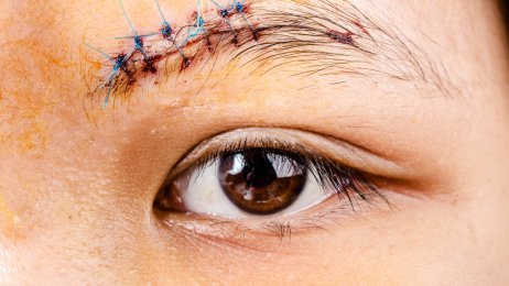 Arr over et øye. Bildet viser et arr med sting over et øyebryn.