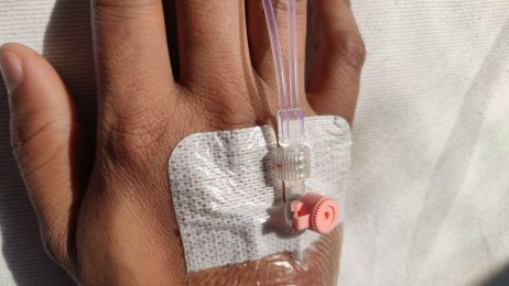 Bildet viser en hånd med perifert venekateter