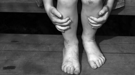 Illustrasjonsbilde av barn som er skadet. Illustrasjonsbilde av barn som er skadet.