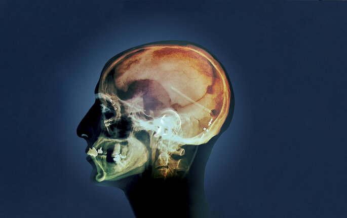 Bildet viser et røntgenbilde av et hode sett fra siden, der man kan se shunten inne i hodet.