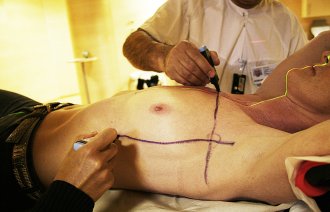 Bildet viser en kvinne med brystkreft som ligger klar til stråling. Legen tegner opp streker der det skal stråles.