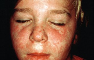 Bildet viser et barn med utslett i ansiktet forårsaket av meslinger