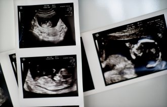 Tidlig ultralydbilder