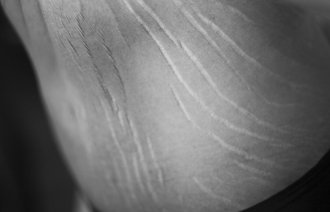Seksualitet Bildet viser deler av en naken kropp med strekkmerker