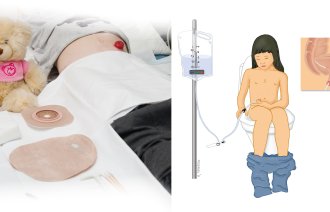 Bildet viser ei jente med kolostomi. På stellebordet ligger pose og annet utstyr. Illustrasjonen viser et barn med blindtarmsstomi som sitter på toalettet og skyller tarmen med skyllepose og kateter inne i stomien. 