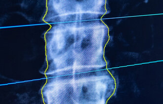 Bilde viser røntgen av en ryggrad