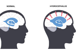 Illustrasjonen viser et hode sett fra siden med en normal hjerne. Til høyre for den vises et hode fra siden med en hjerne som har hydrocefalus.
