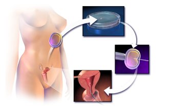 Illustrasjonen viser in vitro-fertilisering