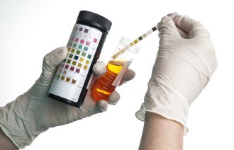 Hender som holder et glass med urin som skal undersøkes med en urinstiks