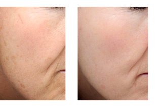 Før-og-etter-bilder