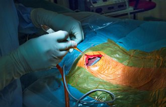 Parkinson-operasjon, stimulator på brystet, Rikshospitalet, OUS