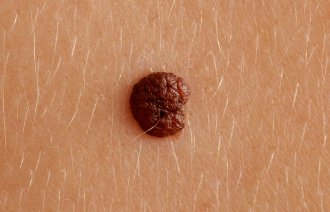 Nærbilde av føflekk