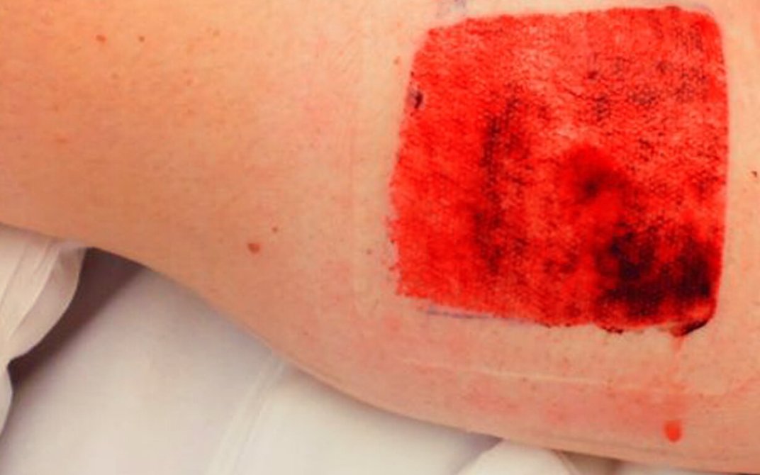 Sår dagen etter operasjon