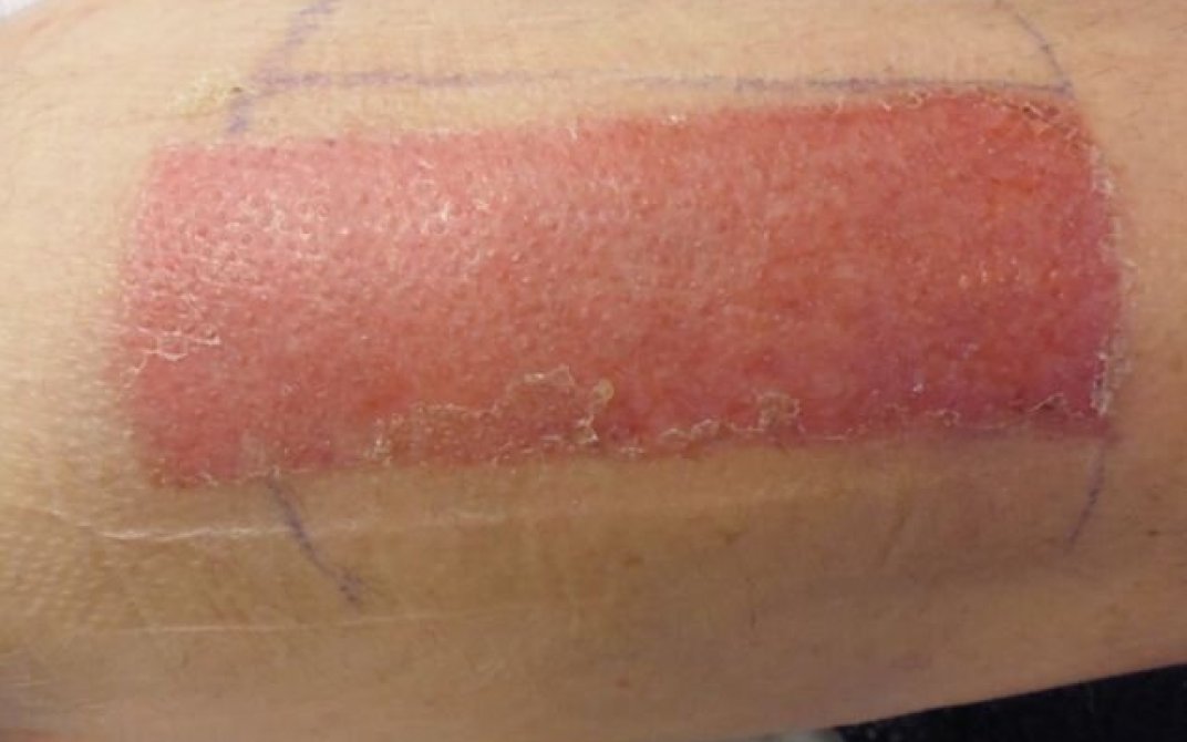 Sår to uker etter operasjon