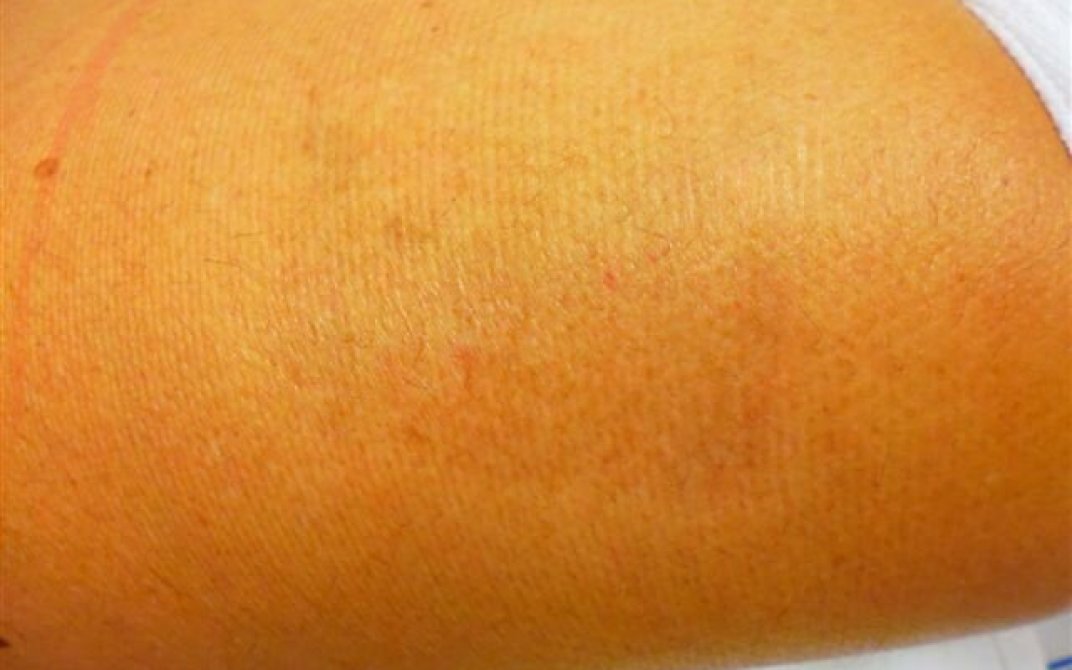 Sår tre måneder etter operasjon