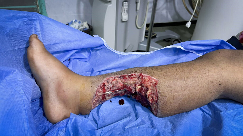 Bildet viser legg med sår etter eksplosjon