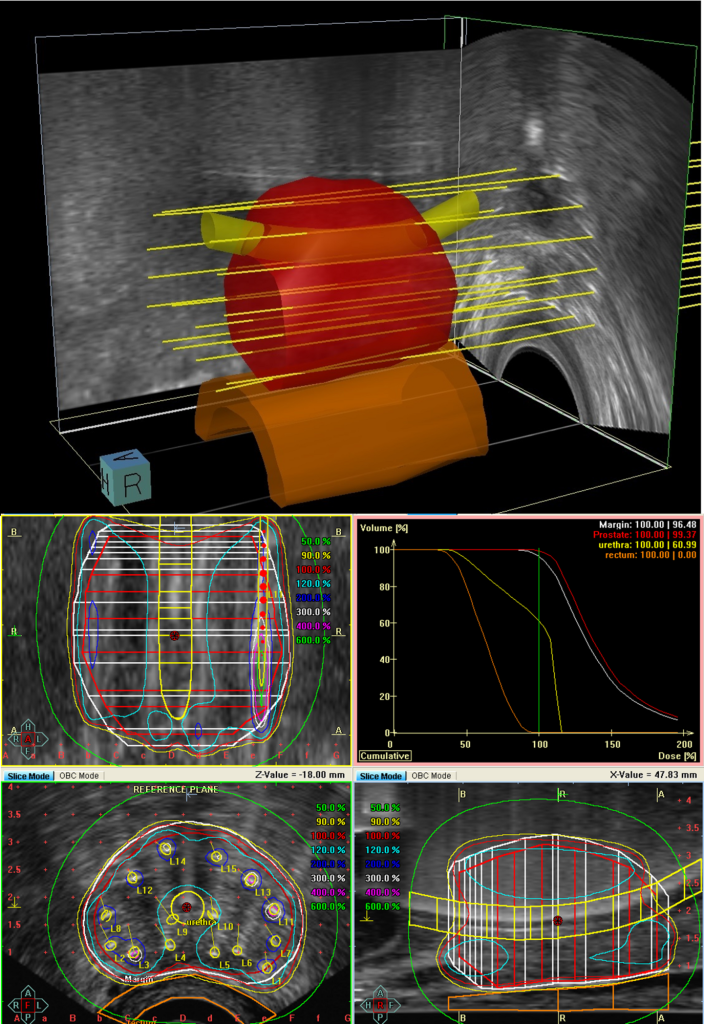 Ultralydbilde av prostata ved brakyterapi Ultralydbilde av prostata ved brakyterapi