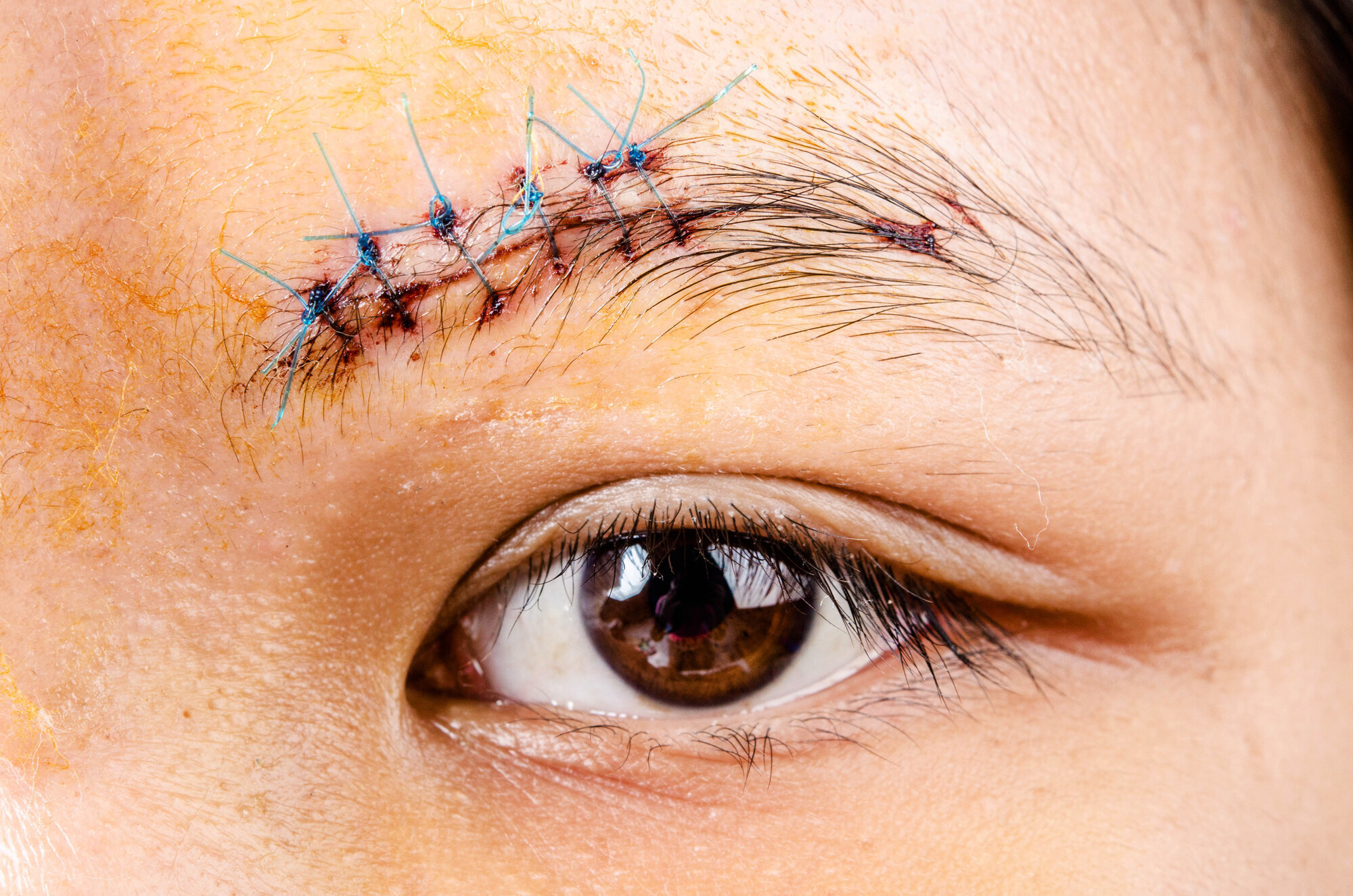 Arr over et øye. Bildet viser et arr med sting over et øyebryn.