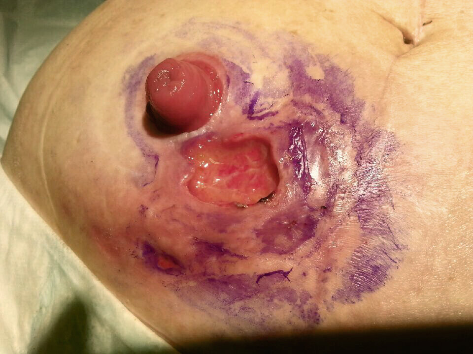 Sår ved stomi Sår ved stomi