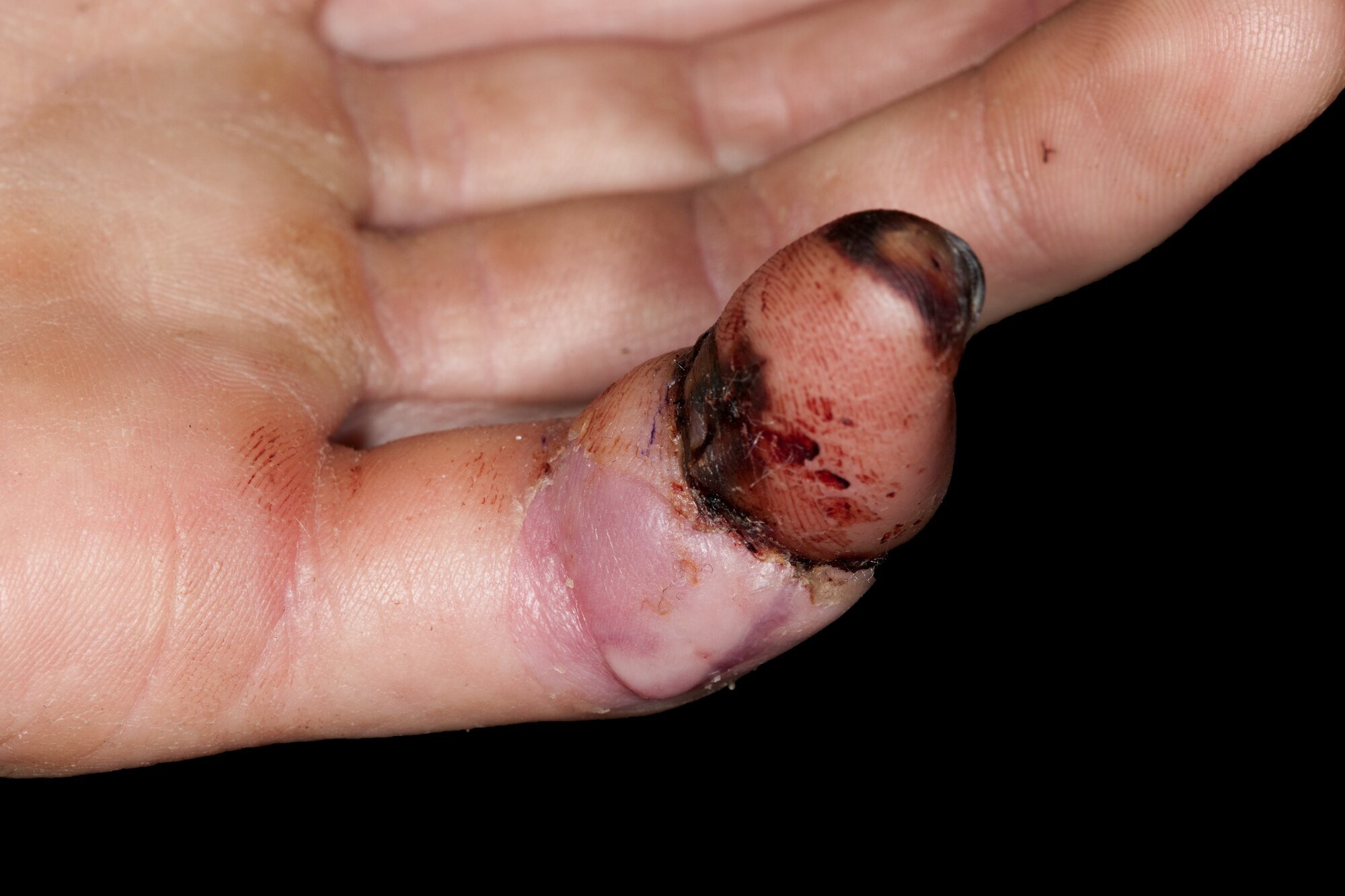 Replantert lillefinger Replantert lillefinger