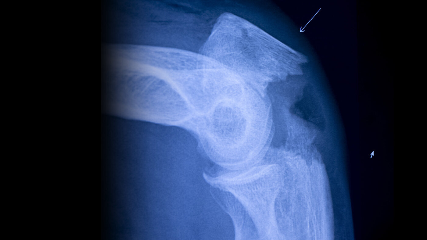 Røntgenbilde av et brudd. Bildet viser et røntgenbilde av et brudd.