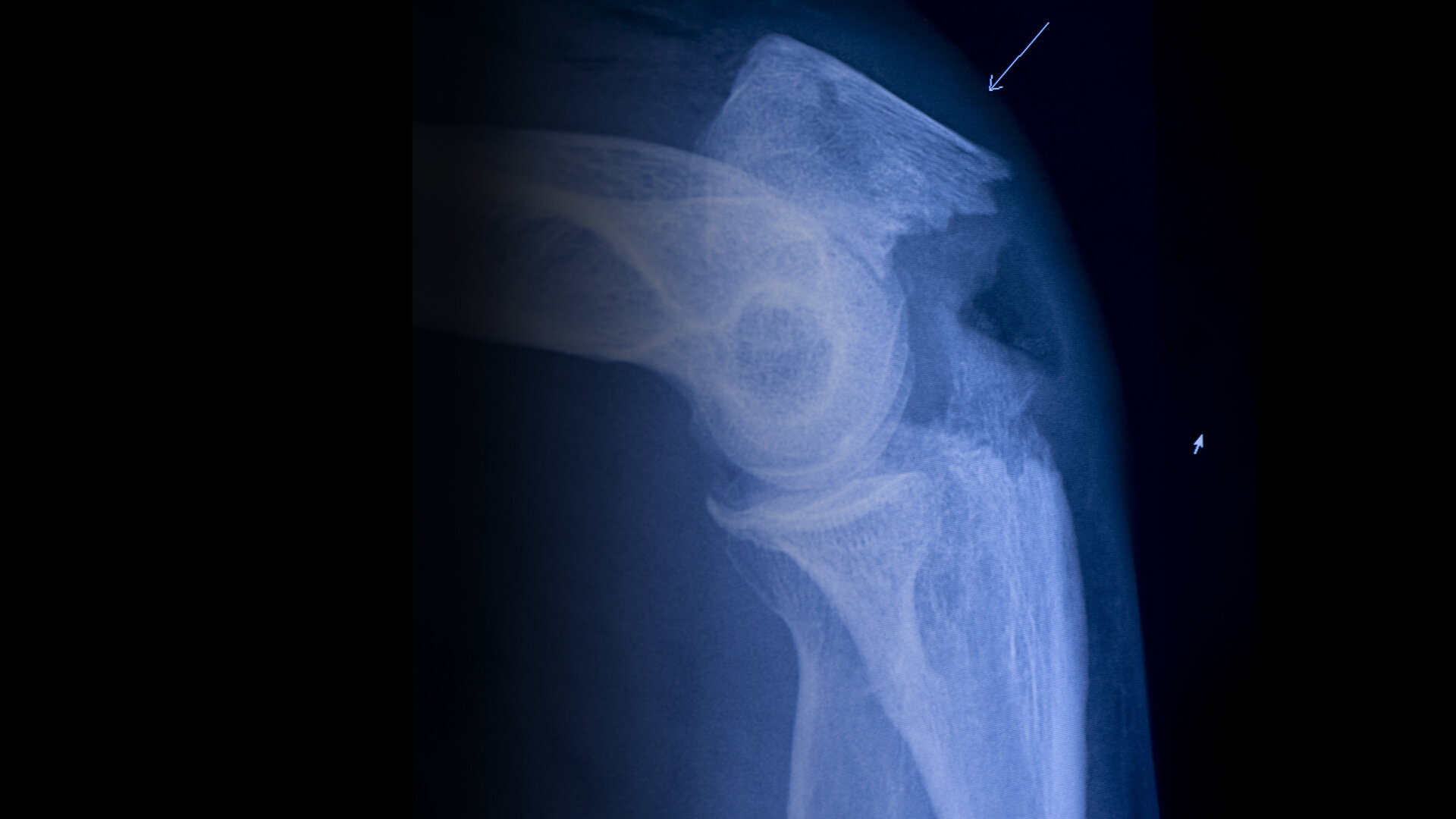 Bildet viser et røntgenbilde av et brudd.