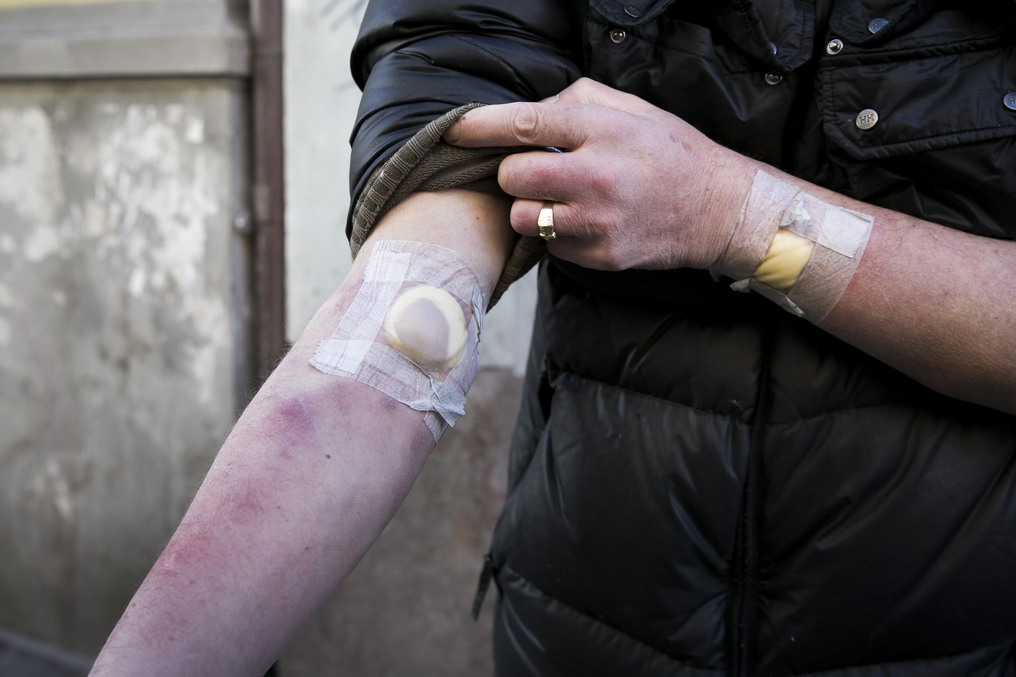 Arm Bildet viser armen til en person som har injisert rusmidler i en lengre periode