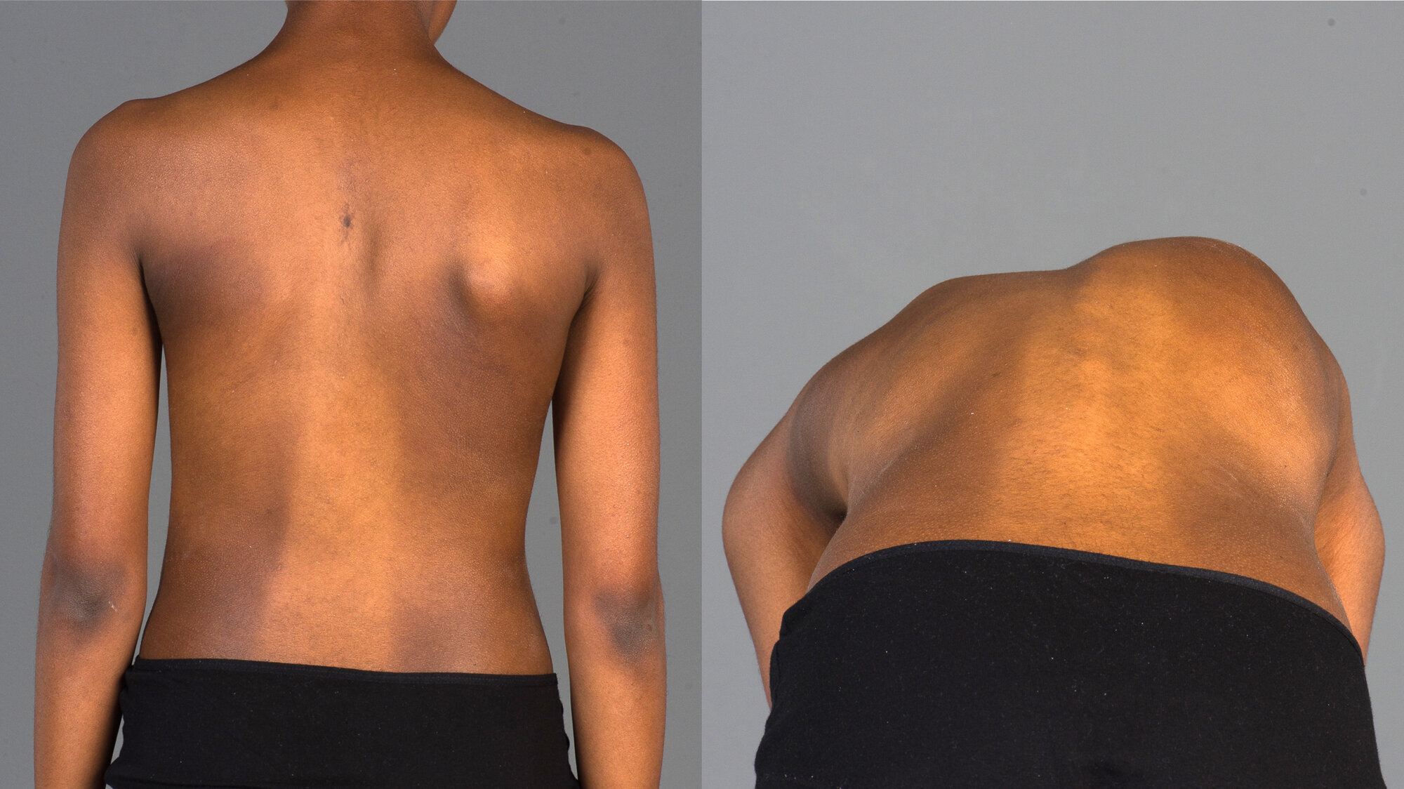 Adam's forward bend test Bildet viser en ung person som bøyer seg fremover og avdekker en skoliose i ryggen