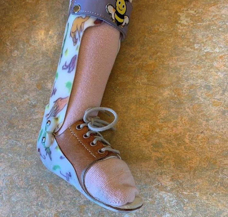 Bildet viser en fot med ortose.