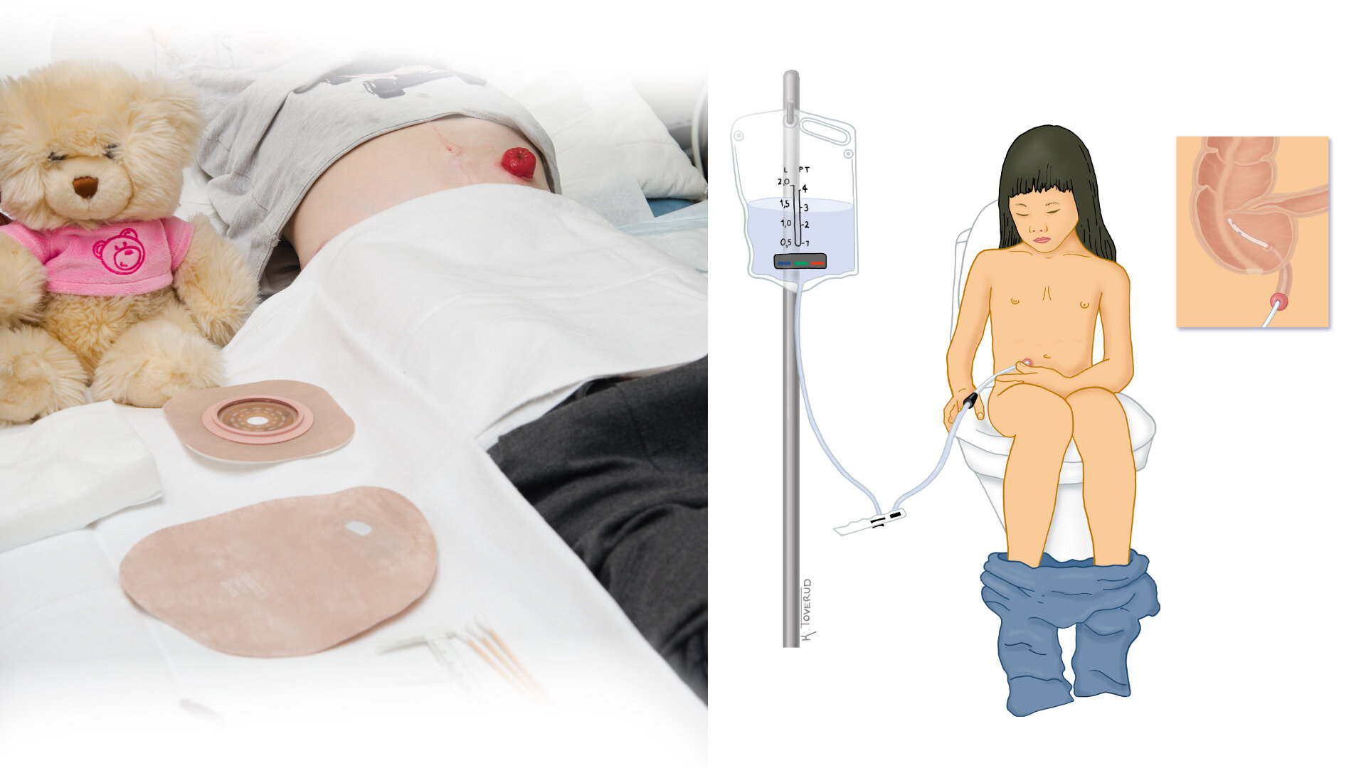 Barn med stomi Bildet viser ei jente med kolostomi. På stellebordet ligger pose og annet utstyr. Illustrasjonen viser et barn med blindtarmsstomi som sitter på toalettet og skyller tarmen med skyllepose og kateter inne i stomien.