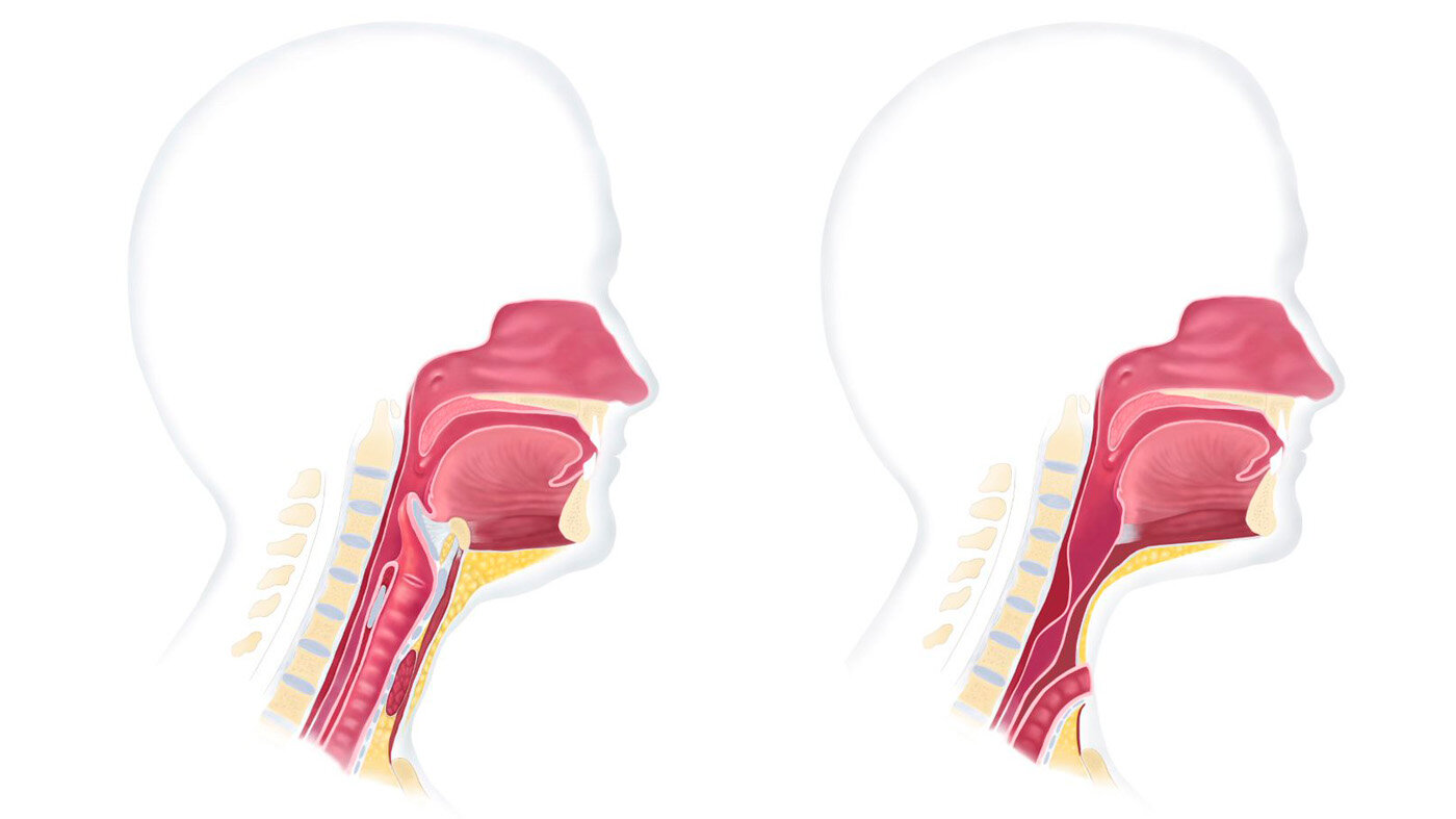 Luftveisanatomi før og etter laryngektomi Illustrasjonen viser normal luftveisanatomi før operasjon og etter operasjon, der strupen er operert bort og luftrøret lagt frem på halsen.