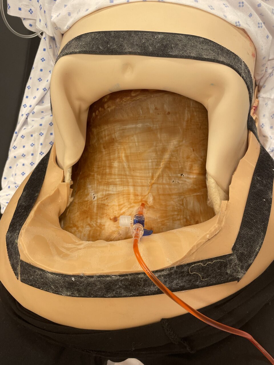 bukhinne fylles med blod bildet viser bukhinne fylles med blod