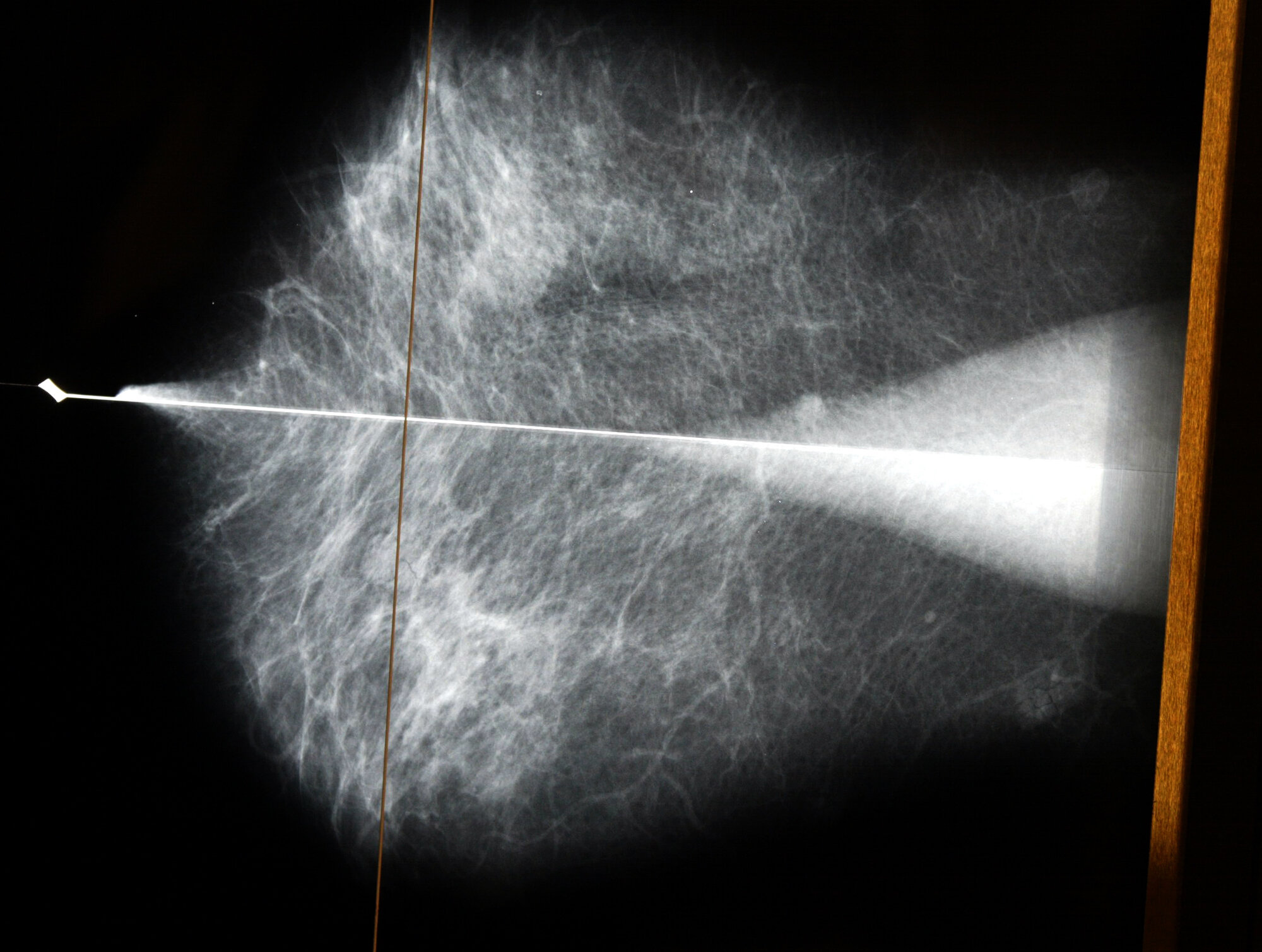 Brystkreft Brystkreft