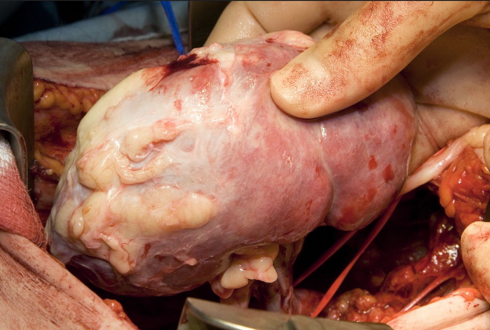 Bilde viser transplantasjon av nyre Bilde viser transplantasjon av nyre