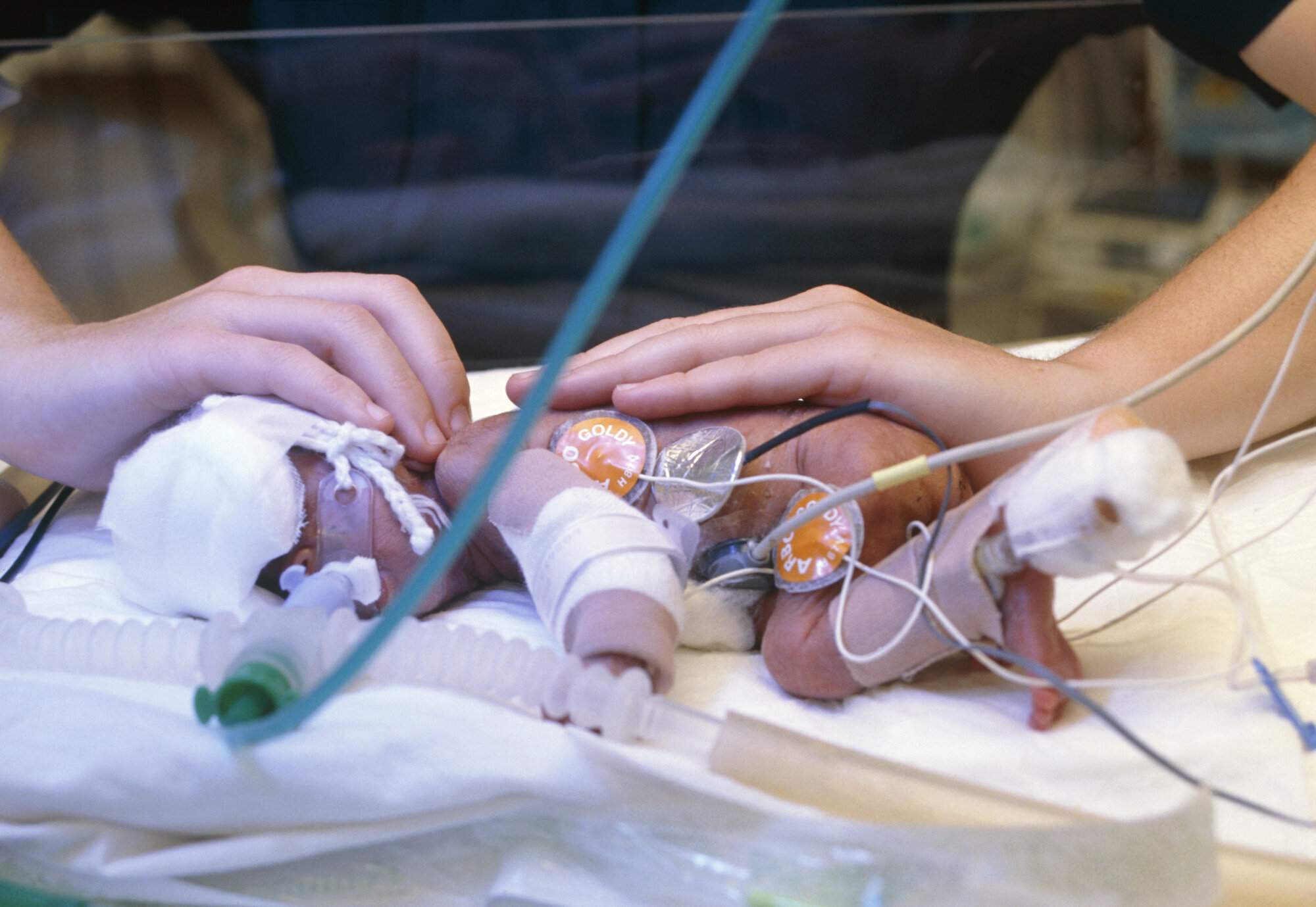 Baby, prematur Bildet viser et ekstremt prematurt barn.