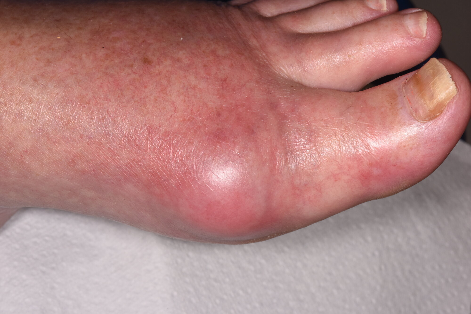 Bildet viser fot med urinsyre-gikt Bildet viser fot med urinsyre-gikt