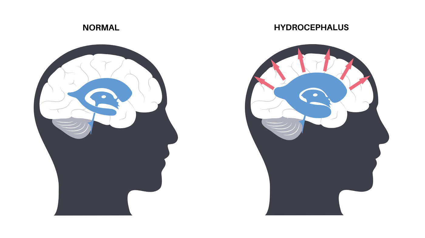 Hydrocefalus Illustrasjonen viser et hode sett fra siden med en normal hjerne. Til høyre for den vises et hode fra siden med en hjerne som har hydrocefalus.