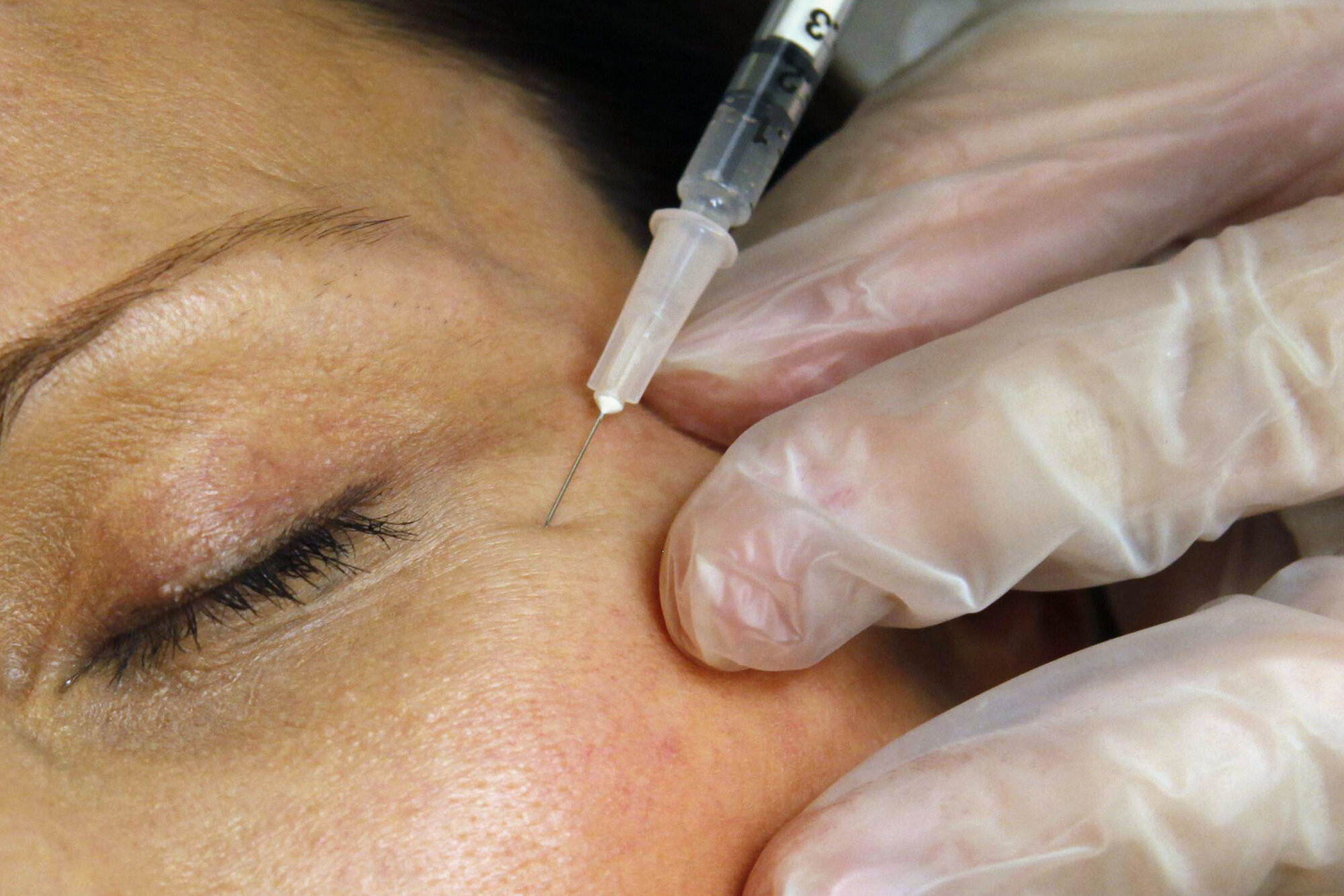 Bildet viser botox-injeksjon
