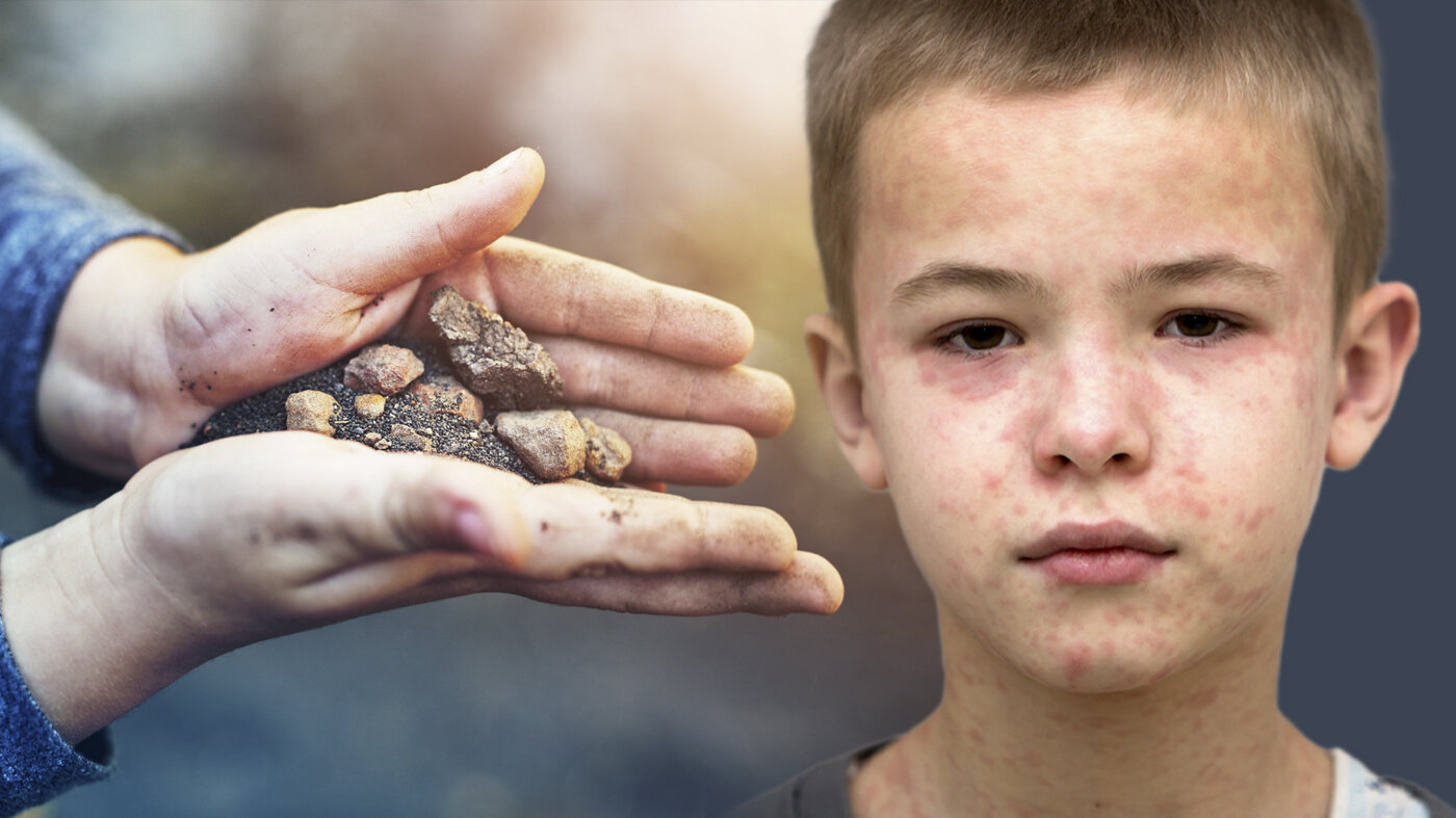 Barnehender med jord og gutt med meslinger Bildet viser et par barnehender som holder noe jord og sand. Til høyre i bildet er ansiktet til en gutt som har meslinger