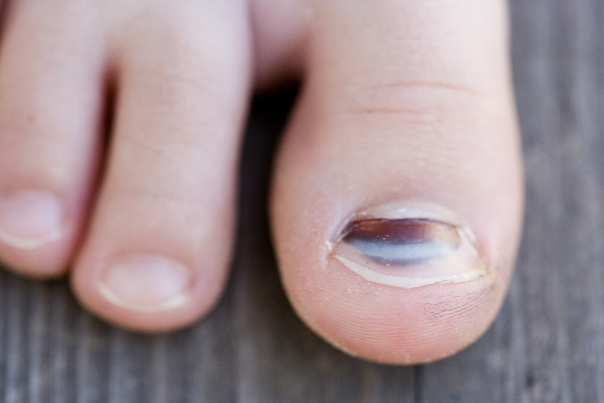 Illustrasjon av negler