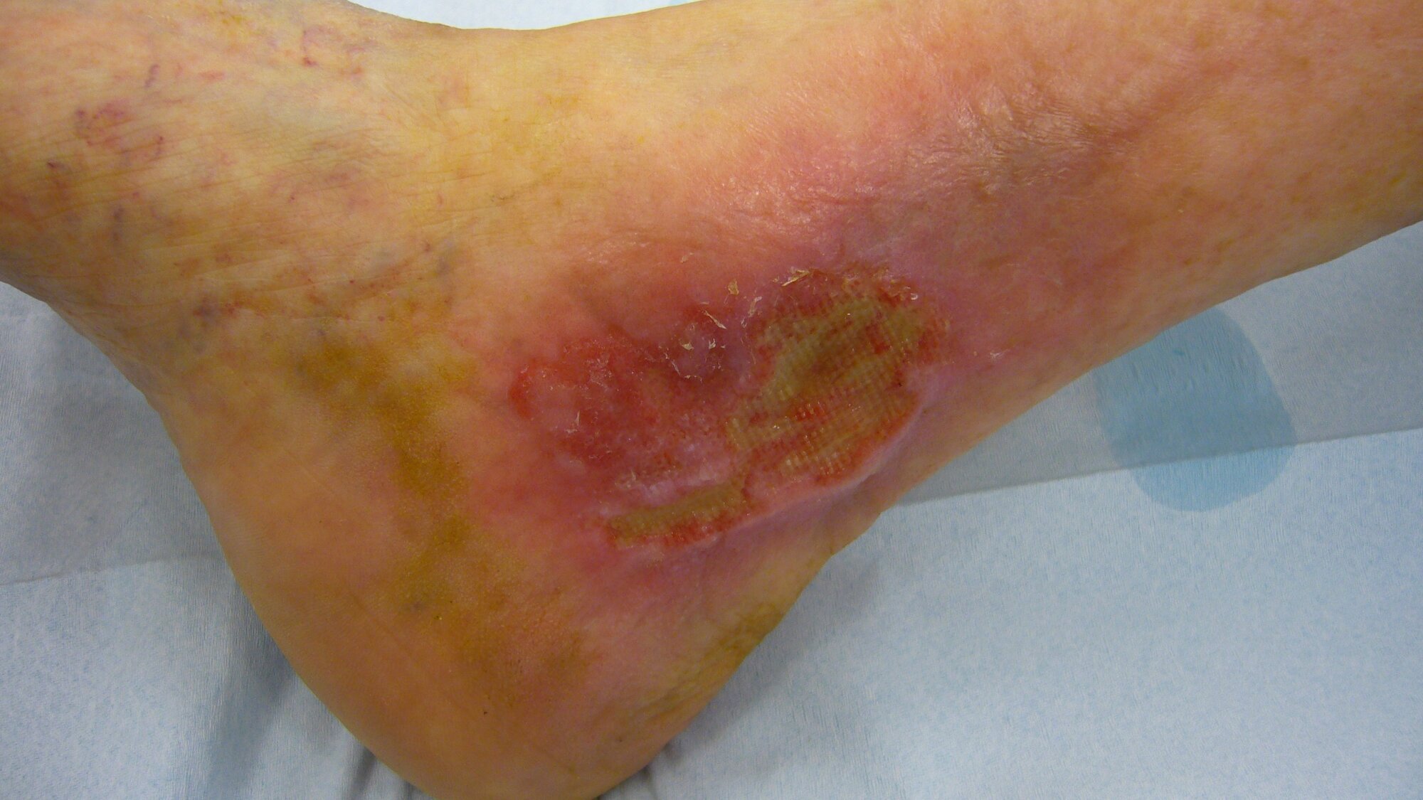 Bildet viser et venøst leggsår