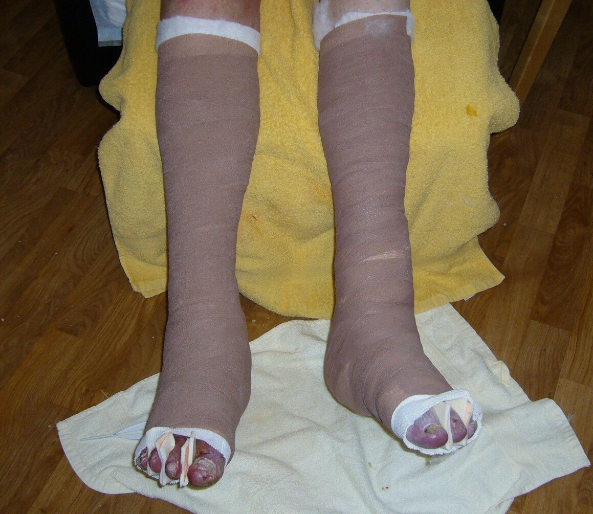 Bildet viser en kompresjonsbandasje