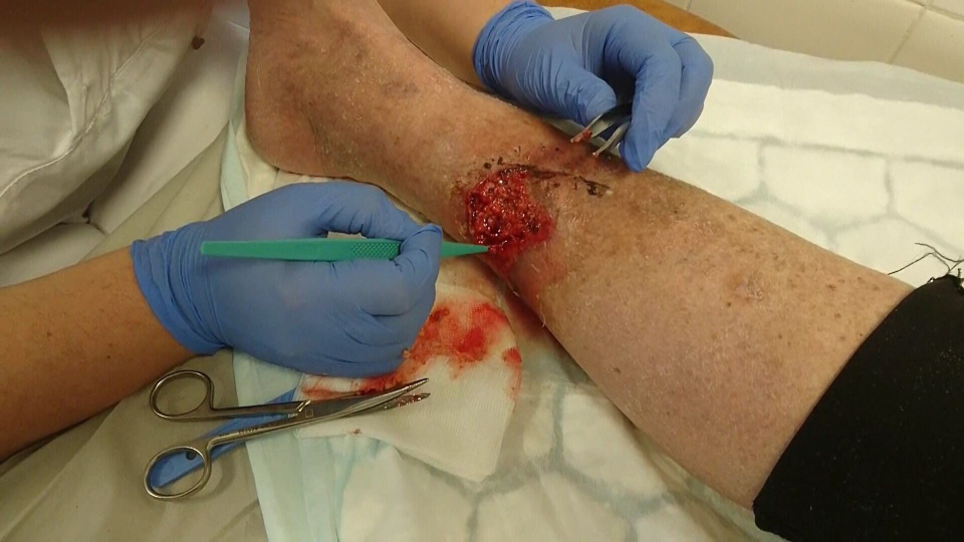 Bildet viser skarp debridering utført ved hjelp av engangskyrette.