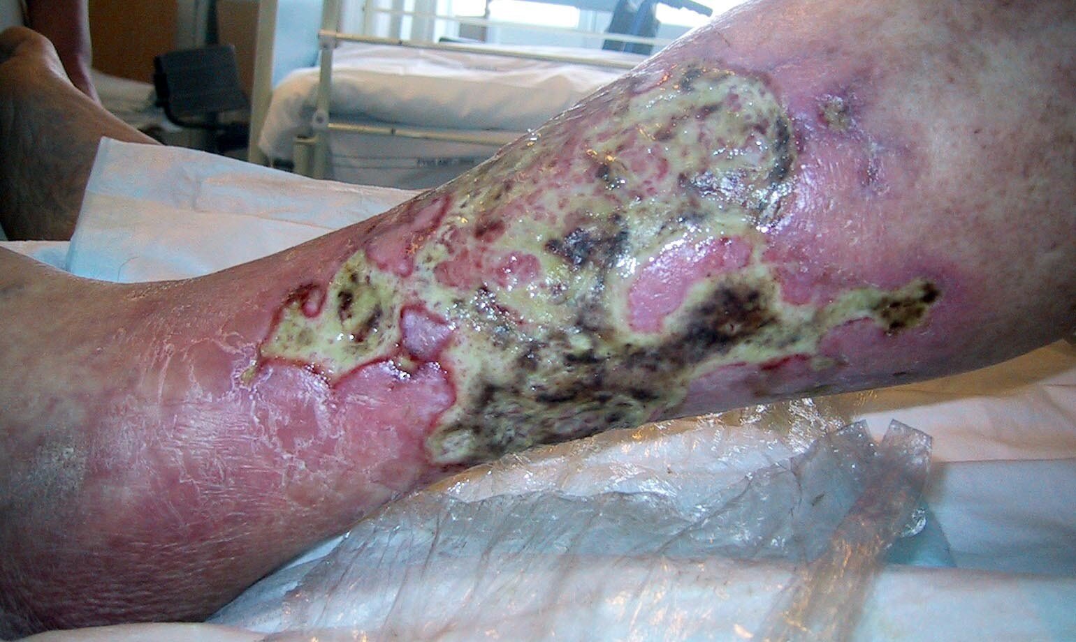 Bildet viser et Infisert venøst leggsår