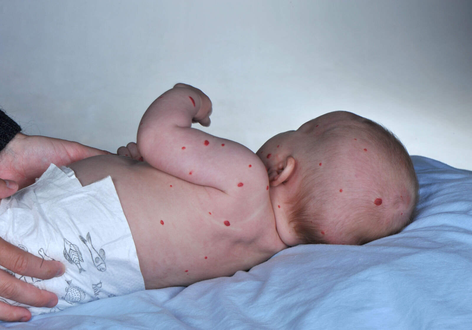 MANGE HEMANGIOMER: Dersom barnet har mer enn fem hemangiomer, er det økt risiko for at det også har slike i indre organer. MANGE HEMANGIOMER: Dersom barnet har mer enn fem hemangiomer, er det økt risiko for at det også har hemangiomer i indre organer.