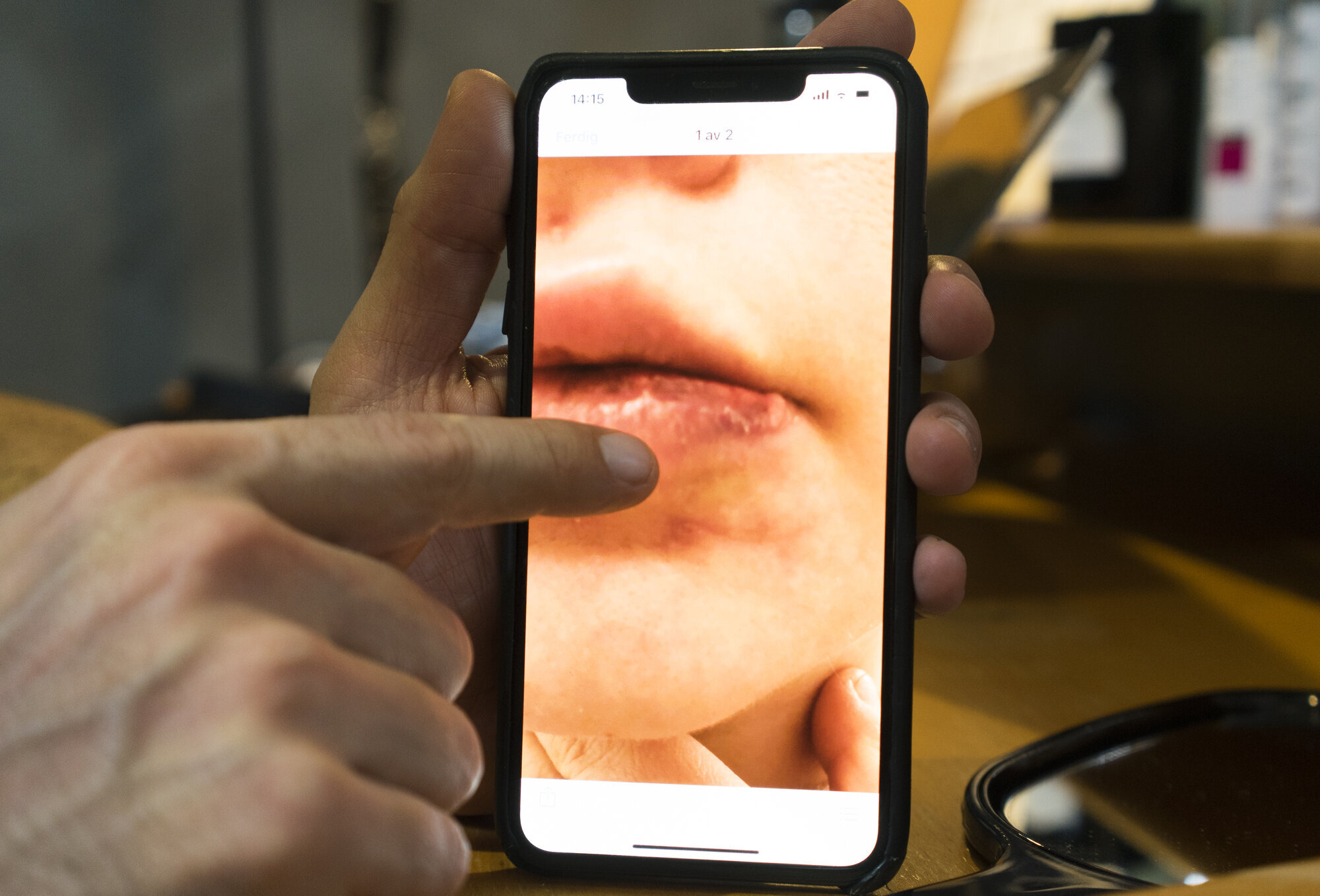 Komplikasjon med filler Bildet viser komplikasjon med filler