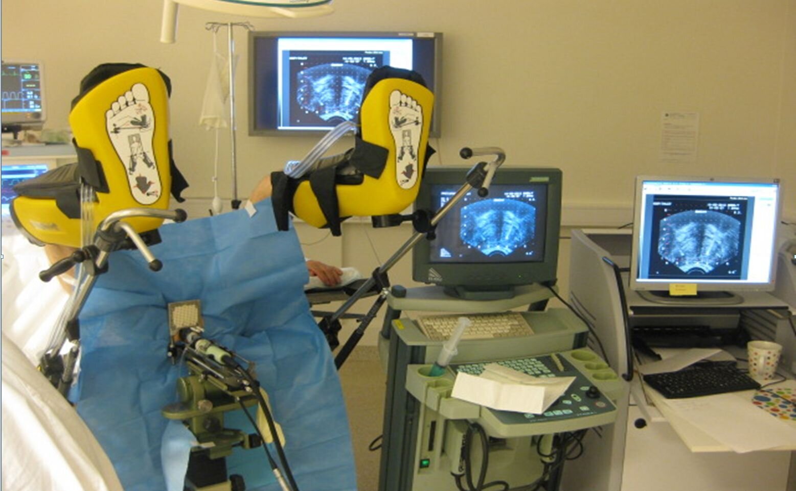 Pasient som gjennomgår brakyterapi Pasient som gjennomgår brakyterapi