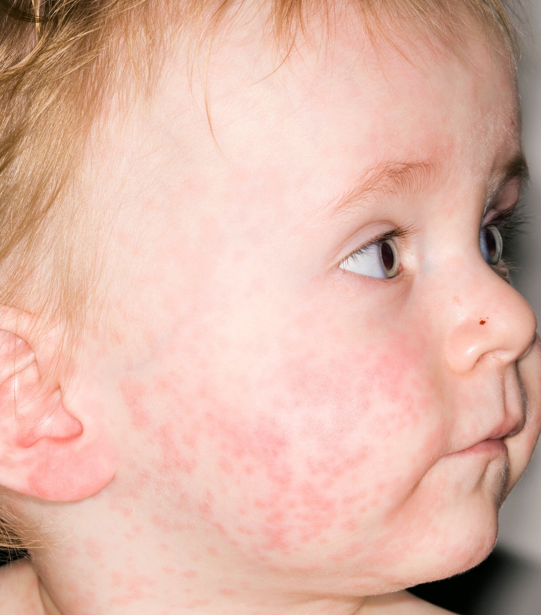 meslinger, smittsom sykdom Bildet viser et lite barn med meslinger.